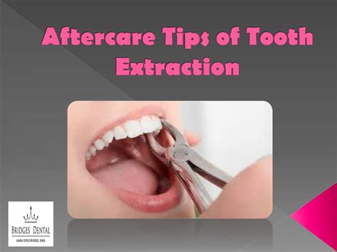 PPT - Best Aftercare Tips of Tooth Extraction by Brandon Dentist | Bridges Dental PowerPoint ...
