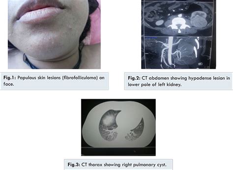Birt- Hogg- Dube Syndrome: Difficulties in Diagnosis and Management in ...