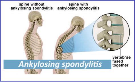 Ankylosis Spondylitis Homeopathic treatment