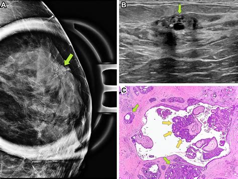 Papilloma Tumor Breast