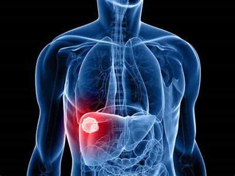 Human liver fluke infection, liver fluke life cycle, symptoms & treatment