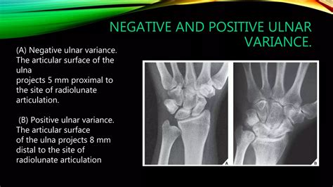 Positive Ulnar Variance