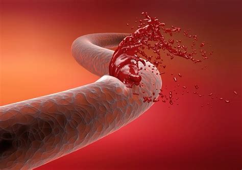 Epidemiologi Disseminated Intravascular Coagulation (DIC) - Alomedika