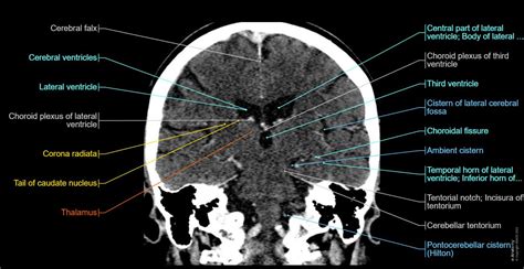 Normal Head CT Scan Anatomy Made Simple- Neuroradiology, 40% OFF