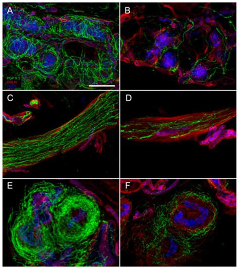 Contribution of Skin Biopsy in Peripheral Neuropathies