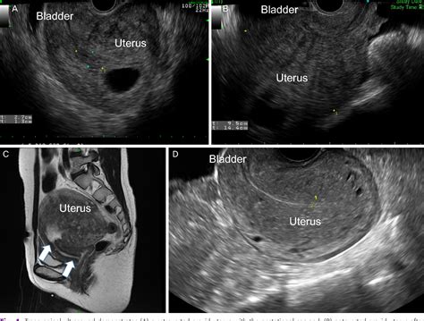 Figure 1 from Incarceration of early gravid uterus with adenomyosis and ...