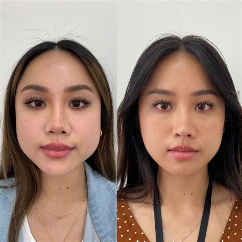 PDO Thread Lift in Newport Beach | Beauty Boost Med Spa in 2024 | Beauty boost, Botox fillers ...