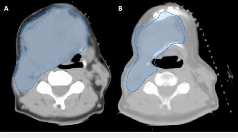 CT Simulation Procedure 的图像结果