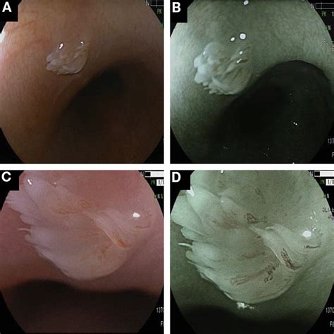Polyps In Oesophagus