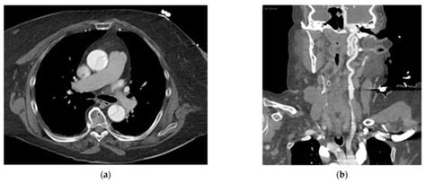 Navigating the Unexpected: Iatrogenic Aortic Injuries during ...