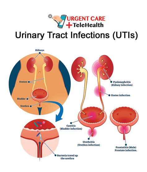 UTI Treatment in Napa, Sonoma & Benicia Urgent Care + TeleHealth
