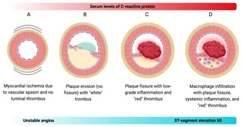 C-Reactive Protein: The Quintessential Marker of Systemic Inflammation in Coronary Artery ...