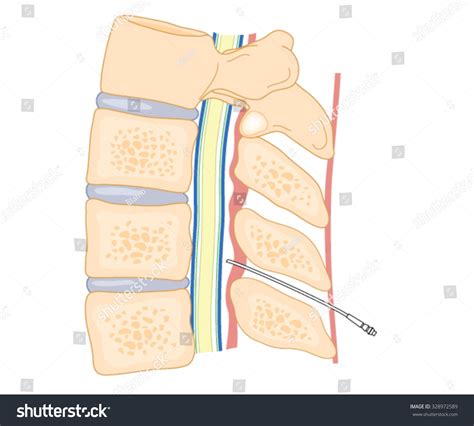 1,759 Epidurals Images, Stock Photos & Vectors | Shutterstock