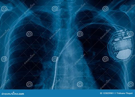 Pacemaker engine in heart stock image. Image of maker - 123029981