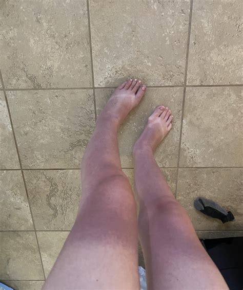 Purple sunburn?? : r/medical