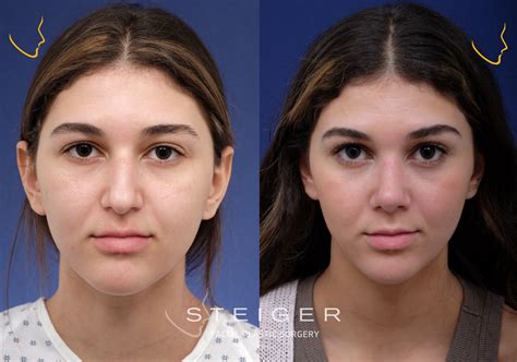 rhinoplasty-before-and-after-hump | Steiger Facial Plastic Surgery | Boca Raton Facelift ...