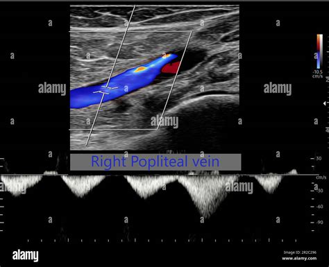 Color Doppler ultrasound determination in deep vein thrombosis patients for finding deep vein ...