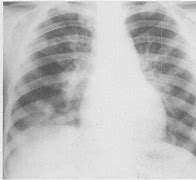 肺吸虫病 的图像结果