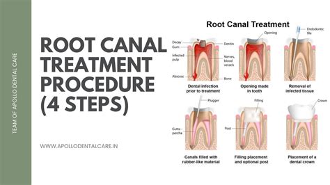 What Is Root Canal Treatment Of Teeth at Kevin Davidson blog