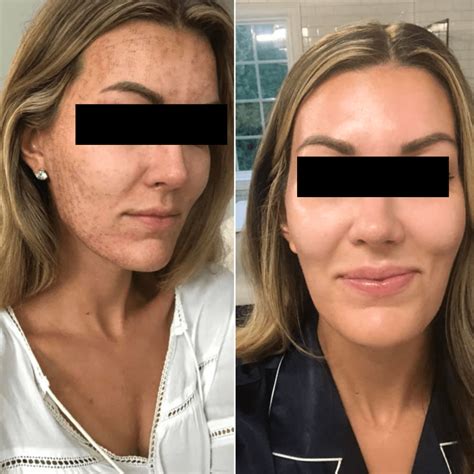 MAGNUS RF 5 MHZ Machine Quantus ITALY Microneedling Radio Frequency Ma ...