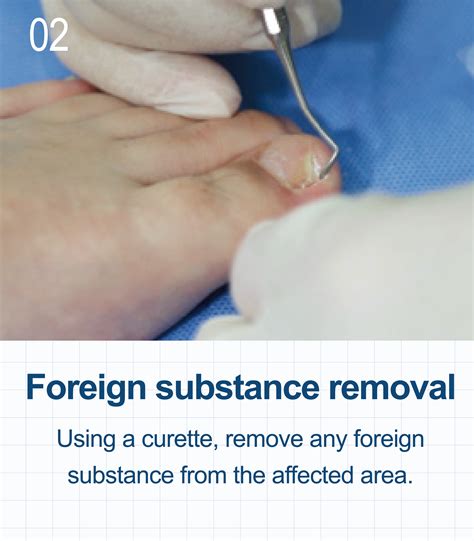 Onycho Clip - TERASYS (Domestic)