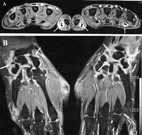 Rheumatoid Arthritis Hands X Ray Half Dose Of MRI Contrast Feasible