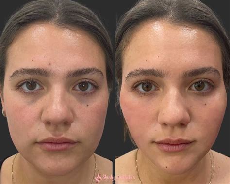 PDO Thread Lifting - Before and After Results at Skinly Aesthetics