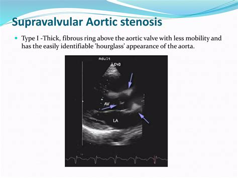 Aortic stenosis - Echocardiography | PPTX