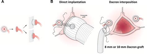 Complex Bentall Operation: Clinical Pearls to Standardize the Procedure ...