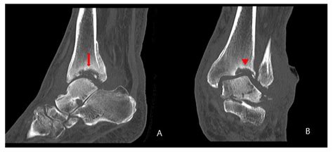 Iatrogenic Ankle Charcot Neuropathic Arthropathy after Spinal Surgery ...