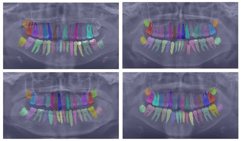 Mask-Transformer-Based Networks for Teeth Segmentation in Panoramic ...