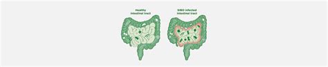 Small Intestinal Bacterial Overgrowth (SIBO) treatment in Mumbai ...