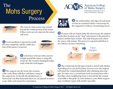 What Is Mohs Surgery? | Arizona Mohs Surgery & Dermatology | Tucson, AZ