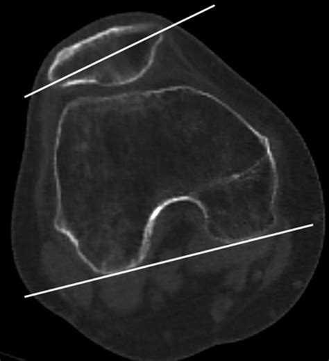 Changes in axial alignment of the ipsilateral hip and knee after total hip arthroplasty | Bone ...