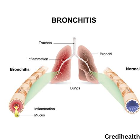 What Triggers Bronchitis