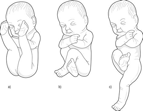Breech Presentation - Clinical Tree