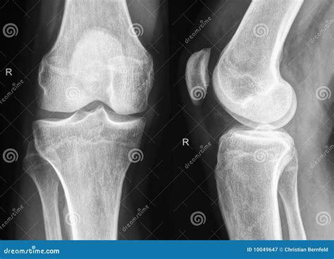Right Knee X-Ray Royalty Free Stock Photography - Image: 10049647
