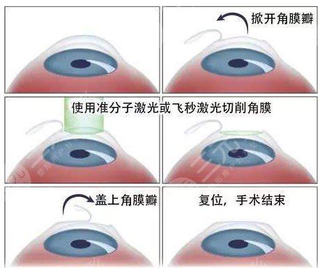 近视眼激光手术“利与弊”的最全解读！_角膜