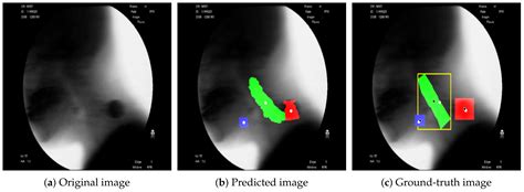 Hyoid Bone Tracking in a Videofluoroscopic Swallowing Study Using a ...