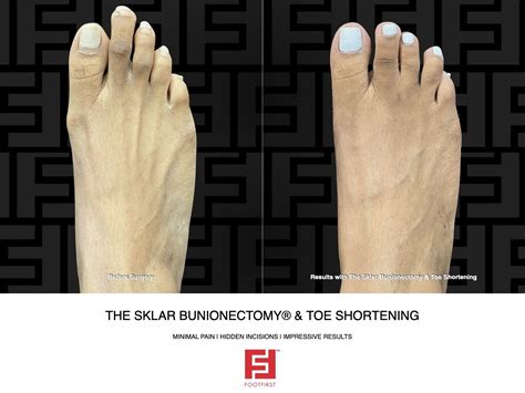 Pinky Toe Bunion Removal