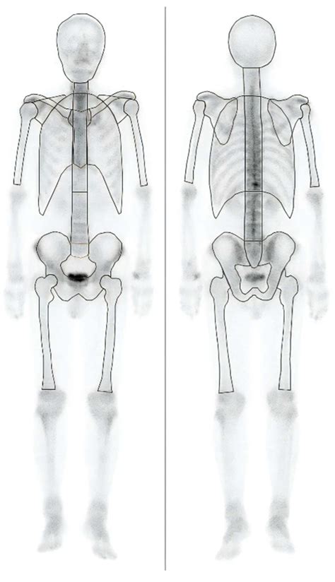 Improving the Accuracy of Bone-scintigraphy Imaging Analysis Using the ...