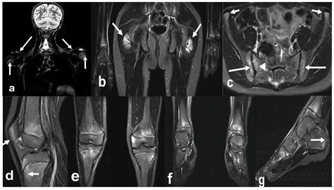 Advances in Musculoskeletal Imaging in Juvenile Idiopathic Arthritis