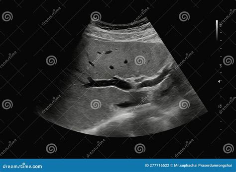 Ultrasound Upper Abdomen for Diagnosis Abdominal Pain Stock Photo ...