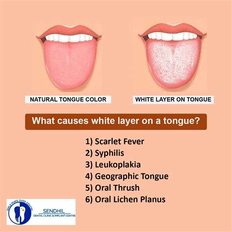 White colored tongue | Tongue health, Dental health care, Dental clinic