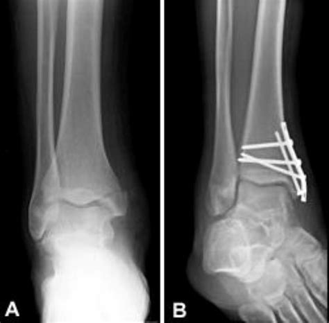 Ankle Fractures (Broken Ankle) - OrthoInfo - AAOS