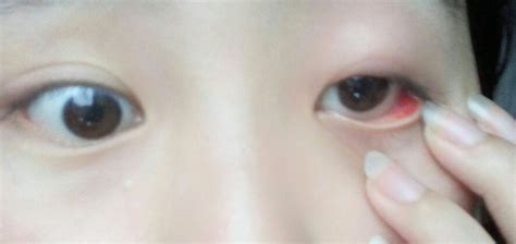 从5天前开始，眼睛肿痛，眼皮发红，刚开始是左下眼皮红肿疼痛，眼皮里面还有白色的小痘痘，现在白色小点_百度知道