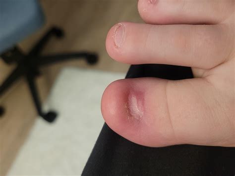 Full Toenail Extraction 的图像结果