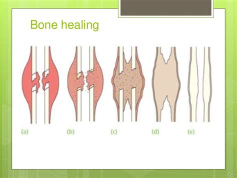 Image result for Bone Healing Process