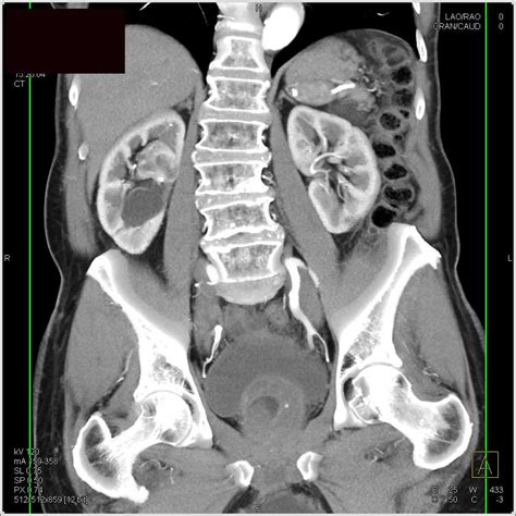 Kuvatulokset haulle parapelvic cyst kidney