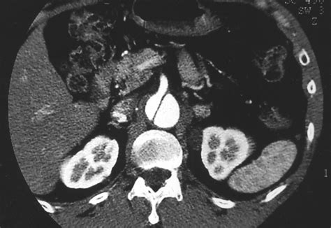 Helical CT in the Evaluation of the Acute Abdomen | AJR